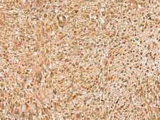 HIRIP3 Antibody - Immunohistochemistry of paraffin-embedded Human liver cancer tissue  using HIRIP3 Polyclonal Antibody at dilution of 1:60(×200)
