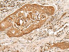 HIRIP3 Antibody - Immunohistochemistry of paraffin-embedded Human esophagus cancer tissue  using HIRIP3 Polyclonal Antibody at dilution of 1:60(×200)