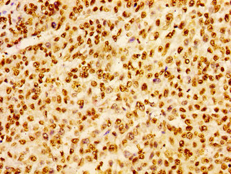 HIST1H1B Antibody - Immunohistochemistry image of paraffin-embedded human colon cancer at a dilution of 1:100