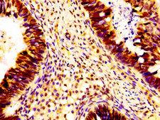 HIST1H1B Antibody - Immunohistochemistry image of paraffin-embedded human ovarian cancer at a dilution of 1:100