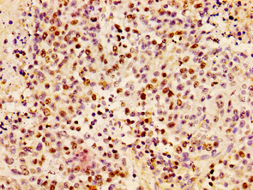 HIST1H1B Antibody - Immunohistochemistry image of paraffin-embedded human colon cancer at a dilution of 1:100