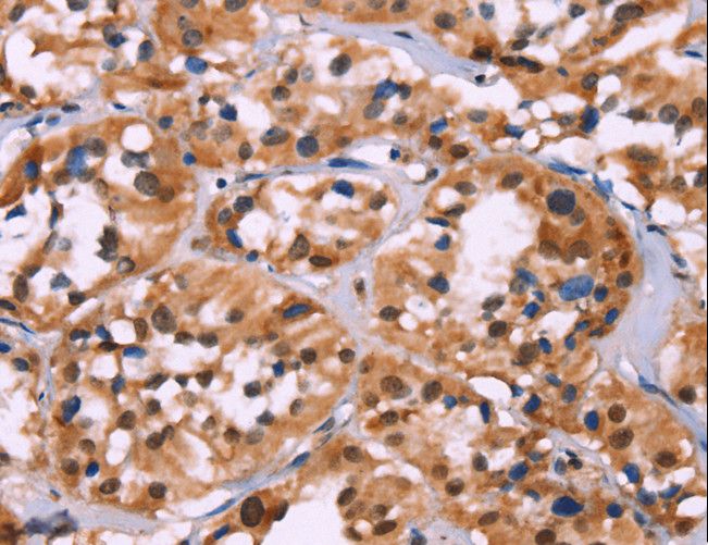 HIST1H1C Antibody - Immunohistochemistry of paraffin-embedded Human thyroid cancer using HIST1H1C Polyclonal Antibody at dilution of 1:70.