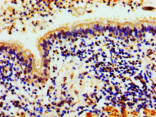 HIST1H1C Antibody - Immunohistochemistry image of paraffin-embedded human lung cancer at a dilution of 1:100