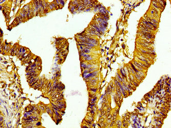 HIST1H1C Antibody - Immunohistochemistry image of paraffin-embedded human colon cancer at a dilution of 1:100