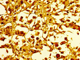 HIST1H1C Antibody - Immunohistochemistry image at a dilution of 1:10 and staining in paraffin-embedded human melanoma cancer performed on a Leica BondTM system. After dewaxing and hydration, antigen retrieval was mediated by high pressure in a citrate buffer (pH 6.0) . Section was blocked with 10% normal goat serum 30min at RT. Then primary antibody (1% BSA) was incubated at 4 °C overnight. The primary is detected by a biotinylated secondary antibody and visualized using an HRP conjugated SP system.