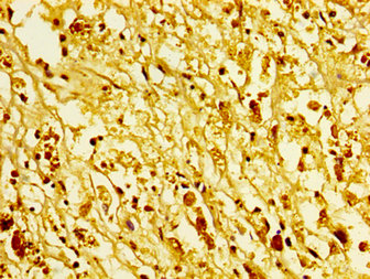 HIST1H1C Antibody - Immunohistochemistry image at a dilution of 1:5 and staining in paraffin-embedded human melanoma cancer performed on a Leica BondTM system. After dewaxing and hydration, antigen retrieval was mediated by high pressure in a citrate buffer (pH 6.0) . Section was blocked with 10% normal goat serum 30min at RT. Then primary antibody (1% BSA) was incubated at 4 °C overnight. The primary is detected by a biotinylated secondary antibody and visualized using an HRP conjugated SP system.