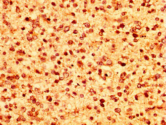 HIST1H1C Antibody - Immunohistochemistry image at a dilution of 1:50 and staining in paraffin-embedded human glioma cancer performed on a Leica BondTM system. After dewaxing and hydration, antigen retrieval was mediated by high pressure in a citrate buffer (pH 6.0) . Section was blocked with 10% normal goat serum 30min at RT. Then primary antibody (1% BSA) was incubated at 4 °C overnight. The primary is detected by a biotinylated secondary antibody and visualized using an HRP conjugated SP system.
