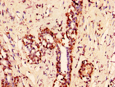 HIST1H1C Antibody - Immunohistochemistry image at a dilution of 1:50 and staining in paraffin-embedded human breast cancer performed on a Leica BondTM system. After dewaxing and hydration, antigen retrieval was mediated by high pressure in a citrate buffer (pH 6.0) . Section was blocked with 10% normal goat serum 30min at RT. Then primary antibody (1% BSA) was incubated at 4 °C overnight. The primary is detected by a biotinylated secondary antibody and visualized using an HRP conjugated SP system.