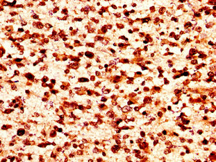 HIST1H1C Antibody - Immunohistochemistry image at a dilution of 1:50 and staining in paraffin-embedded human glioma cancer performed on a Leica BondTM system. After dewaxing and hydration, antigen retrieval was mediated by high pressure in a citrate buffer (pH 6.0) . Section was blocked with 10% normal goat serum 30min at RT. Then primary antibody (1% BSA) was incubated at 4 °C overnight. The primary is detected by a biotinylated secondary antibody and visualized using an HRP conjugated SP system.