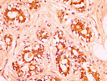 HIST1H1C Antibody - Immunohistochemistry image at a dilution of 1:50 and staining in paraffin-embedded human breast cancer performed on a Leica BondTM system. After dewaxing and hydration, antigen retrieval was mediated by high pressure in a citrate buffer (pH 6.0) . Section was blocked with 10% normal goat serum 30min at RT. Then primary antibody (1% BSA) was incubated at 4 °C overnight. The primary is detected by a biotinylated secondary antibody and visualized using an HRP conjugated SP system.
