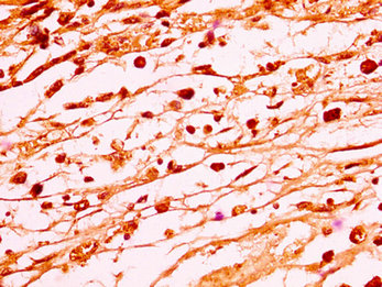 HIST1H1C Antibody - Immunohistochemistry image at a dilution of 1:50 and staining in paraffin-embedded human melanoma cancer performed on a Leica BondTM system. After dewaxing and hydration, antigen retrieval was mediated by high pressure in a citrate buffer (pH 6.0) . Section was blocked with 10% normal goat serum 30min at RT. Then primary antibody (1% BSA) was incubated at 4 °C overnight. The primary is detected by a biotinylated secondary antibody and visualized using an HRP conjugated SP system.