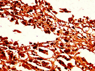 HIST1H1C Antibody - Immunohistochemistry image at a dilution of 1:50 and staining in paraffin-embedded human melanoma cancer performed on a Leica BondTM system. After dewaxing and hydration, antigen retrieval was mediated by high pressure in a citrate buffer (pH 6.0) . Section was blocked with 10% normal goat serum 30min at RT. Then primary antibody (1% BSA) was incubated at 4 °C overnight. The primary is detected by a biotinylated secondary antibody and visualized using an HRP conjugated SP system.