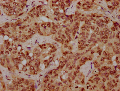 HIST1H1C Antibody - Immunohistochemistry Dilution at 1:10 and staining in paraffin-embedded human liver cancer performed on a Leica BondTM system. After dewaxing and hydration, antigen retrieval was mediated by high pressure in a citrate buffer (pH 6.0). Section was blocked with 10% normal Goat serum 30min at RT. Then primary antibody (1% BSA) was incubated at 4°C overnight. The primary is detected by a biotinylated Secondary antibody and visualized using an HRP conjugated SP system.