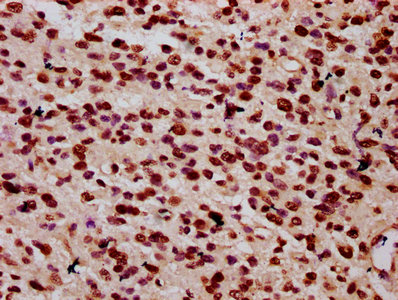 HIST1H1C Antibody - Immunohistochemistry Dilution at 1:10 and staining in paraffin-embedded human glioma cancer performed on a Leica BondTM system. After dewaxing and hydration, antigen retrieval was mediated by high pressure in a citrate buffer (pH 6.0). Section was blocked with 10% normal Goat serum 30min at RT. Then primary antibody (1% BSA) was incubated at 4°C overnight. The primary is detected by a biotinylated Secondary antibody and visualized using an HRP conjugated SP system.