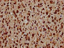 HIST1H1C Antibody - Immunohistochemistry Dilution at 1:20 and staining in paraffin-embedded human glioma cancer performed on a Leica BondTM system. After dewaxing and hydration, antigen retrieval was mediated by high pressure in a citrate buffer (pH 6.0). Section was blocked with 10% normal Goat serum 30min at RT. Then primary antibody (1% BSA) was incubated at 4°C overnight. The primary is detected by a biotinylated Secondary antibody and visualized using an HRP conjugated SP system.