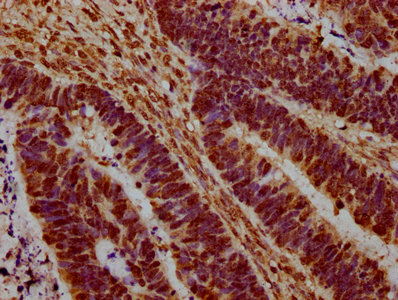 HIST1H1C Antibody - Immunohistochemistry Dilution at 1:20 and staining in paraffin-embedded human ovarian cancer performed on a Leica BondTM system. After dewaxing and hydration, antigen retrieval was mediated by high pressure in a citrate buffer (pH 6.0). Section was blocked with 10% normal Goat serum 30min at RT. Then primary antibody (1% BSA) was incubated at 4°C overnight. The primary is detected by a biotinylated Secondary antibody and visualized using an HRP conjugated SP system.