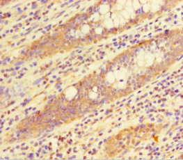 HIST1H1C Antibody - Immunohistochemistry of paraffin-embedded human colon cancer at dilution 1:100