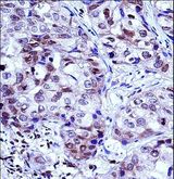HIST1H1D Antibody - HIST1H1D Antibody immunohistochemistry of formalin-fixed and paraffin-embedded human breast carcinoma followed by peroxidase-conjugated secondary antibody and DAB staining.