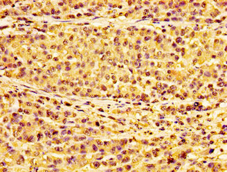 HIST1H1E Antibody - Immunohistochemistry image of paraffin-embedded human colon cancer at a dilution of 1:100