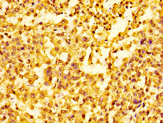 HIST1H1E Antibody - Immunohistochemistry image of paraffin-embedded human colon cancer at a dilution of 1:100