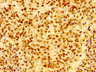 HIST1H1E Antibody - Immunohistochemistry image of paraffin-embedded human colon cancer at a dilution of 1:100