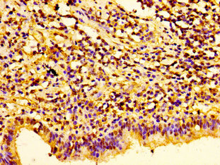 HIST1H1E Antibody - Immunohistochemistry image of paraffin-embedded human lung cancer at a dilution of 1:100