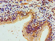 HIST1H1E Antibody - Immunohistochemistry of paraffin-embedded human lung cancer using HIST1H1E (Ab-33) Antibody at dilution of 1:100