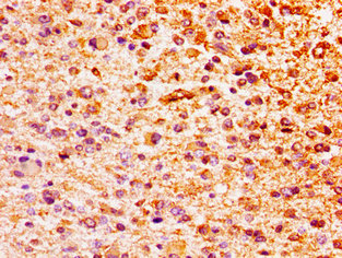 HIST1H1E Antibody - Immunohistochemistry image of paraffin-embedded human glioma cancer at a dilution of 1:100