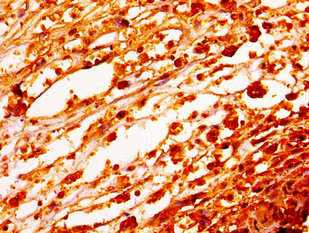 HIST1H1E Antibody - Immunohistochemistry image of paraffin-embedded human melanoma cancer at a dilution of 1:100