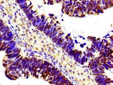HIST1H1E Antibody - Immunohistochemistry image of paraffin-embedded human ovarian cancer at a dilution of 1:100