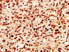 HIST1H1E Antibody - Immunohistochemistry image at a dilution of 1:50 and staining in paraffin-embedded human glioma cancer performed on a Leica BondTM system. After dewaxing and hydration, antigen retrieval was mediated by high pressure in a citrate buffer (pH 6.0) . Section was blocked with 10% normal goat serum 30min at RT. Then primary antibody (1% BSA) was incubated at 4 °C overnight. The primary is detected by a biotinylated secondary antibody and visualized using an HRP conjugated SP system.