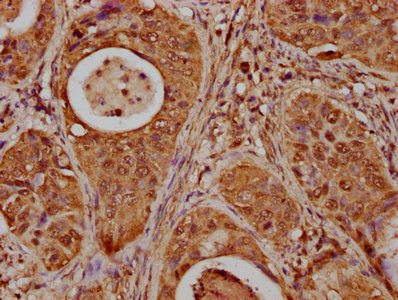 HIST1H1E Antibody - Immunohistochemistry Dilution at 1:20 and staining in paraffin-embedded human cervical cancer performed on a Leica BondTM system. After dewaxing and hydration, antigen retrieval was mediated by high pressure in a citrate buffer (pH 6.0). Section was blocked with 10% normal Goat serum 30min at RT. Then primary antibody (1% BSA) was incubated at 4°C overnight. The primary is detected by a biotinylated Secondary antibody and visualized using an HRP conjugated SP system.