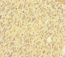 HIST1H2AB Antibody - Immunohistochemistry of paraffin-embedded human glioma cancer at dilution of 1:100