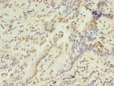HIST1H2AG Antibody - Immunohistochemistry of paraffin-embedded human lung cancer using HIST1H2AG Antibody at dilution of 1:100