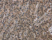 HIST1H2AH Antibody - Immunohistochemistry of paraffin-embedded Human liver cancer using HIST1H2AH Polyclonal Antibody at dilution of 1:40.