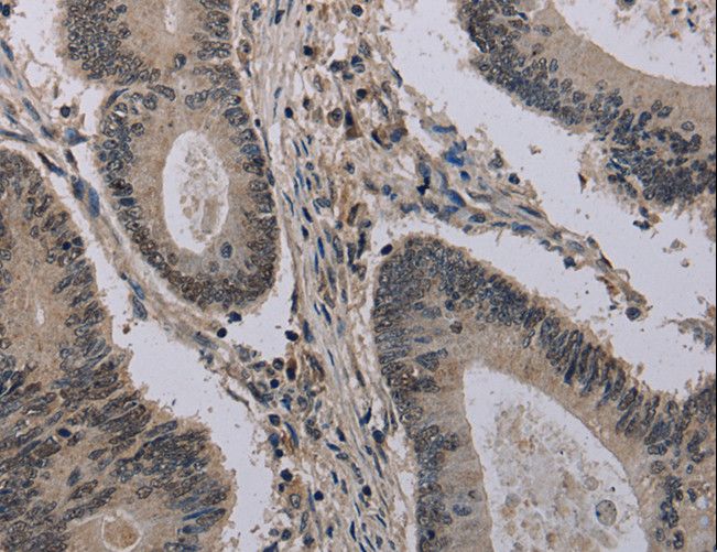 HIST1H2AH Antibody - Immunohistochemistry of paraffin-embedded Human colon cancer using HIST1H2AH Polyclonal Antibody at dilution of 1:40.