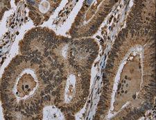 HIST1H2AH Antibody - Immunohistochemistry of paraffin-embedded Human colon cancer using HIST1H2AH Polyclonal Antibody at dilution of 1:40.