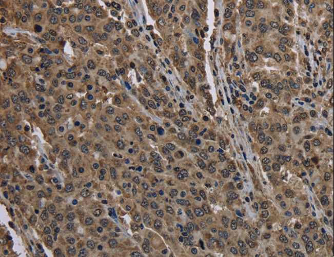 HIST1H2AH Antibody - Immunohistochemistry of paraffin-embedded Human liver cancer using HIST1H2AH Polyclonal Antibody at dilution of 1:40.