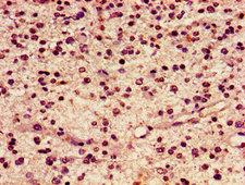 HIST1H2AI Antibody - Immunohistochemistry image of paraffin-embedded human glioma cancer at a dilution of 1:100