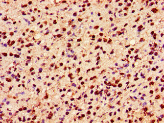HIST1H2AI Antibody - Immunohistochemistry image of paraffin-embedded human glioma cancer at a dilution of 1:100