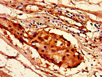 HIST1H2AI Antibody - Immunohistochemistry image of paraffin-embedded human breast cancer at a dilution of 1:100