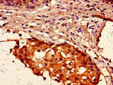 HIST1H2AI Antibody - Immunohistochemistry image of paraffin-embedded human breast cancer at a dilution of 1:100