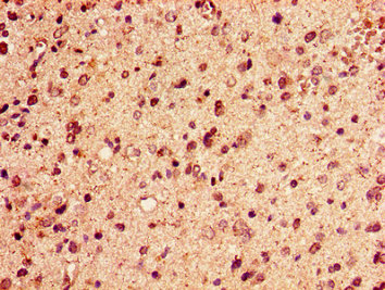 HIST1H2AI Antibody - Immunohistochemistry image of paraffin-embedded human glioma cancer at a dilution of 1:100