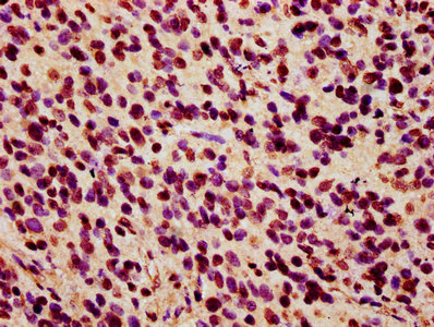HIST1H2AI Antibody - IHC image of HIST1H2AG (Ab-36) Antibody diluted at 1:7 and staining in paraffin-embedded human glioma performed on a Leica BondTM system. After dewaxing and hydration, antigen retrieval was mediated by high pressure in a citrate buffer (pH 6.0). Section was blocked with 10% normal goat serum 30min at RT. Then primary antibody (1% BSA) was incubated at 4°C overnight. The primary is detected by a biotinylated secondary antibody and visualized using an HRP conjugated SP system.