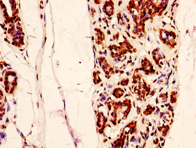 HIST1H2AI Antibody - Immunohistochemistry image at a dilution of 1:50 and staining in paraffin-embedded human breast cancer performed on a Leica BondTM system. After dewaxing and hydration, antigen retrieval was mediated by high pressure in a citrate buffer (pH 6.0) . Section was blocked with 10% normal goat serum 30min at RT. Then primary antibody (1% BSA) was incubated at 4 °C overnight. The primary is detected by a biotinylated secondary antibody and visualized using an HRP conjugated SP system.