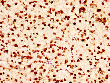 HIST1H2AI Antibody - Immunohistochemistry image at a dilution of 1:50 and staining in paraffin-embedded human glioma cancer performed on a Leica BondTM system. After dewaxing and hydration, antigen retrieval was mediated by high pressure in a citrate buffer (pH 6.0) . Section was blocked with 10% normal goat serum 30min at RT. Then primary antibody (1% BSA) was incubated at 4 °C overnight. The primary is detected by a biotinylated secondary antibody and visualized using an HRP conjugated SP system.