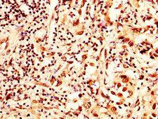 HIST1H2AI Antibody - Immunohistochemistry image at a dilution of 1:50 and staining in paraffin-embedded human liver cancer performed on a Leica BondTM system. After dewaxing and hydration, antigen retrieval was mediated by high pressure in a citrate buffer (pH 6.0) . Section was blocked with 10% normal goat serum 30min at RT. Then primary antibody (1% BSA) was incubated at 4 °C overnight. The primary is detected by a biotinylated secondary antibody and visualized using an HRP conjugated SP system.