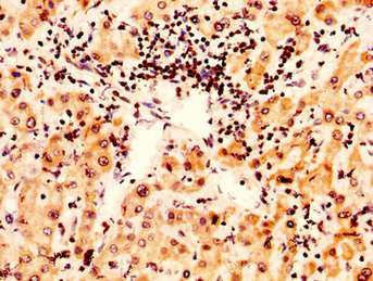 HIST1H2AI Antibody - Immunohistochemistry image at a dilution of 1:50 and staining in paraffin-embedded human liver cancer performed on a Leica BondTM system. After dewaxing and hydration, antigen retrieval was mediated by high pressure in a citrate buffer (pH 6.0) . Section was blocked with 10% normal goat serum 30min at RT. Then primary antibody (1% BSA) was incubated at 4 °C overnight. The primary is detected by a biotinylated secondary antibody and visualized using an HRP conjugated SP system.