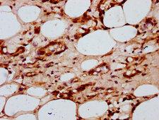 HIST1H2AI Antibody - Immunohistochemistry Dilution at 1:20 and staining in paraffin-embedded human breast cancer performed on a Leica BondTM system. After dewaxing and hydration, antigen retrieval was mediated by high pressure in a citrate buffer (pH 6.0). Section was blocked with 10% normal Goat serum 30min at RT. Then primary antibody (1% BSA) was incubated at 4°C overnight. The primary is detected by a biotinylated Secondary antibody and visualized using an HRP conjugated SP system.