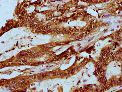 HIST1H2AI Antibody - Immunohistochemistry Dilution at 1:20 and staining in paraffin-embedded human colon cancer performed on a Leica BondTM system. After dewaxing and hydration, antigen retrieval was mediated by high pressure in a citrate buffer (pH 6.0). Section was blocked with 10% normal Goat serum 30min at RT. Then primary antibody (1% BSA) was incubated at 4°C overnight. The primary is detected by a biotinylated Secondary antibody and visualized using an HRP conjugated SP system.